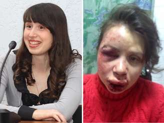 Rosto de Tetiana Chernovil ficou desconfigurado após agressão