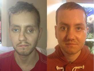 Stephen Power antes e depois da cirurgia; ele sofreu fraturas nos ossos da face, mandíbula superior, nariz e crânio, e passou quatro meses no hospital