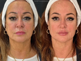 Antes x depois de Nadine Gonçalves, mãe e Neymar, após reconhecimento facial 