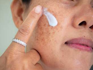 Confira tudo sobre o melasma
