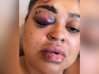 Rizia machucada após acidente.