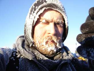Karl Bushby com o rosto congelado em sua travessia no no Alaska