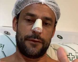 Fred operou o nariz após sofrer fratura em choque com o goleiro rival em jogo-treino do Cruzeiro.