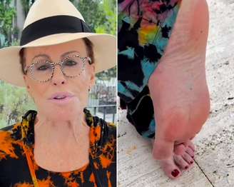 Ana Maria Braga mostrou o pé após ser picada por escorpião