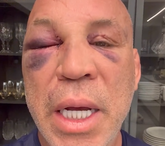 Wanderlei Silva apareceu com o olho bastante inchado em um novo vídeo sobre seu estado de saúde