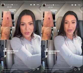Gracyanne Barbosa sofre acidente e mostra fotos pelo Instagram 