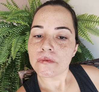Mariana Michelini perdeu os lábios após harmonização com substância proibida