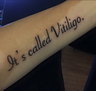 Tiffany Posteraro tatuou o braço com a frase "É chamado de vitiligo" para evitar preconceito 