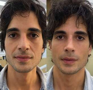 Fiuk mostrou o antes e depois da harmonização facial no 'Fofocalizando'