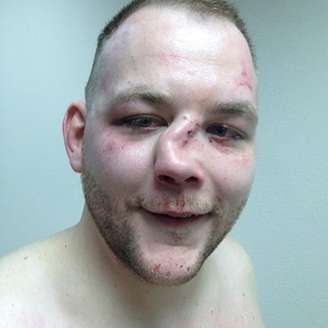<p>Andy Eichholz quebrou feio o nariz em nocaute sofrido para Wade Sauer</p>