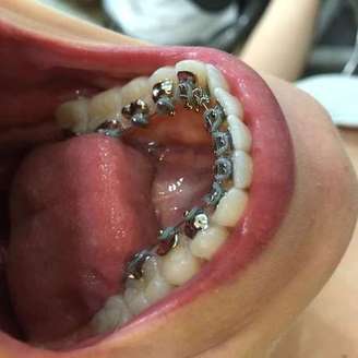 Colocados atrás dos dentes, em contato com a língua, o custo desse tipo de tratamento chega a ser até quatro vezes maior do que o feito com um aparelho convencional
