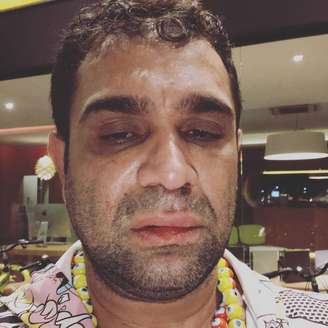 O humorista Evandro Santo mostra que foi agredido por um rapaz após show em Marília, Estado de São Paulo.