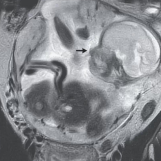 Com fortes cólicas, francesa descobre gravidez de 23 semanas fora do útero