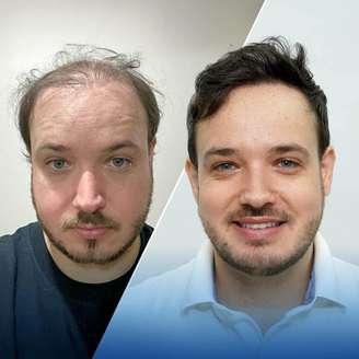 Antes e depois do transplante capilar do cantor Israel 