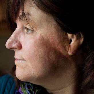 Gina Russo, sobrevivente do incêndio de 2003 na boate The Station, exibe cicatrizes de queimadura na lateral do rosto.