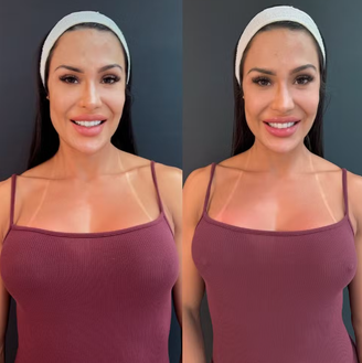 Gracyanne Barbosa fez preenchimento de mamilo