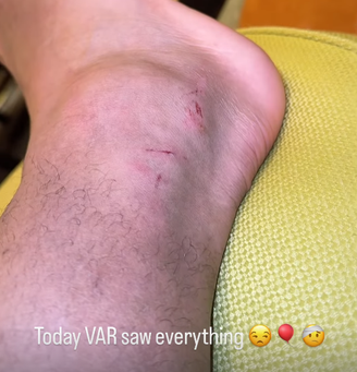 Depay mostra lesões no tornozelo após vitória do Corinthians sobre o Vasco