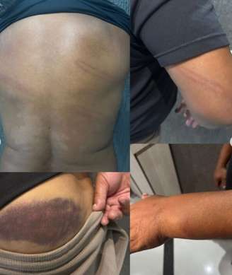O ex-jogador Perdigão divulgou imagens de escoriações pelo corpo após ser agredido por policial militar.