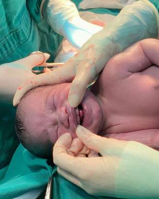 O pequeno Arthur nasceu com alguns dentes e surpreendeu equipe médica