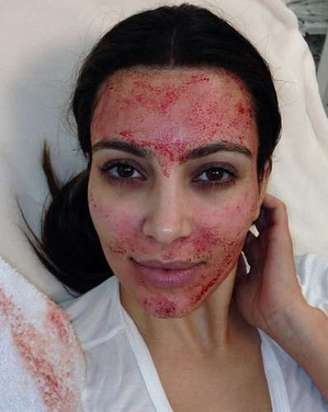 <p>Kim Kardashian já apostou na técnica de tratamento facial com próprio sangue</p>