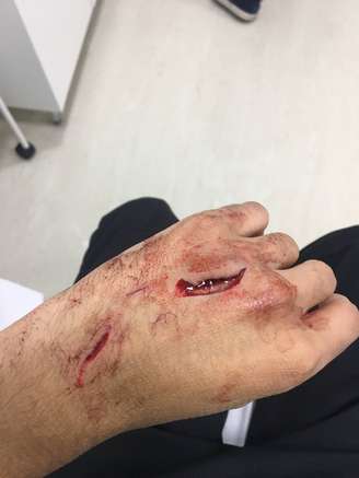 Nas redes sociais, jovem mostrou ferimento causado após tentativa de assalto na estação Trianon-Masp do metrô
