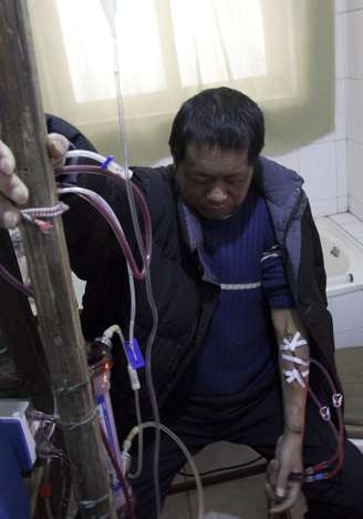 Sem dinheiro para ir ao hospital, Hu Songwen desenvolveu sua própria máquina de hemodiálise