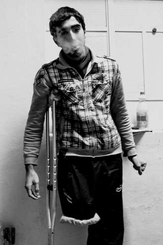 Ahmed perdeu parte da perna direita após ser atingido por um tiro de AK-47