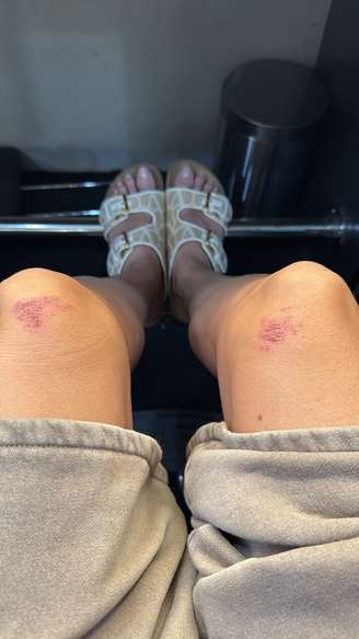 Heidi Klum ficou com hematomas nos joelhos após usar vestido feito de couro e látex no Grammy 2026.