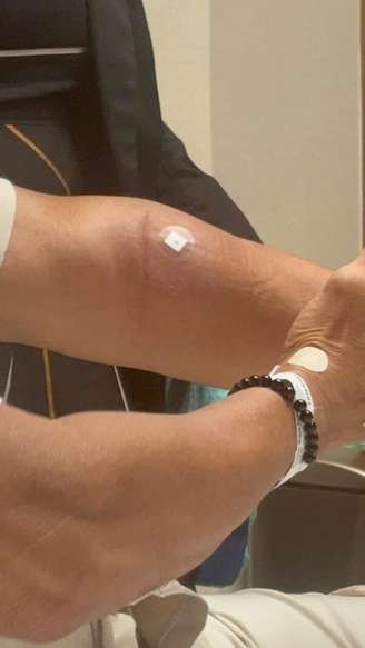 Imagem mostra inchaço em braço do senador Magno Malta após alegada falha em exame realizado em hospital de Brasília