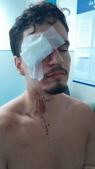Estudante perde a visão após ser atingido por bala de borracha 