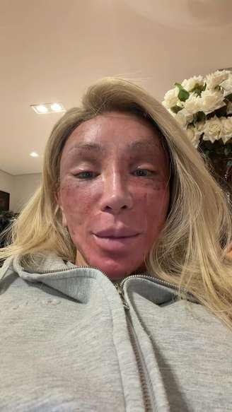Maya Massafera mostra recuperação de peeling facial