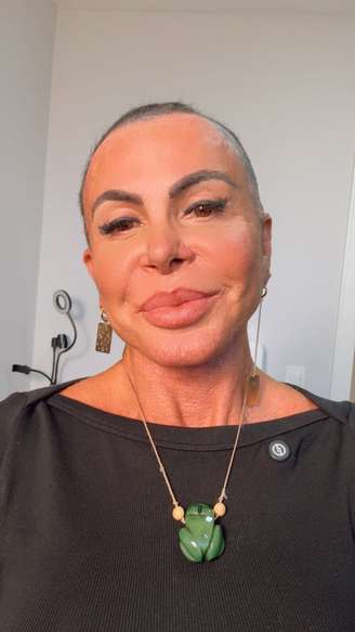Gretchen optou por raspar toda a cabeça antes de passar por transplante capilar