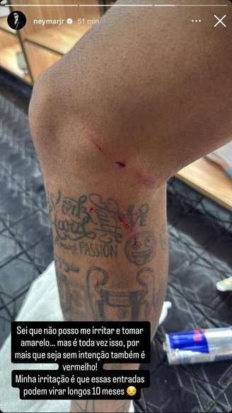Neymar posta foto da perna machucada após duelo com o Fluminense.