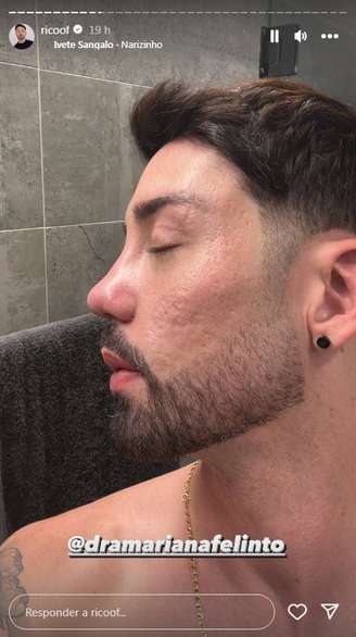 Rico Melquiades mostra resultado com 'antes e depois' de cirurgia plástica no nariz